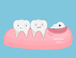 impacted wisdom teeth