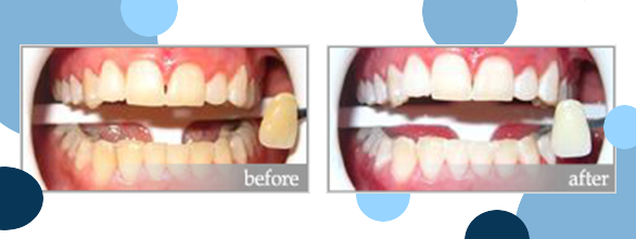 zoom teeth whitening before and after at justSMILE in Ramsgate Sydney NSW